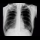 Cavity in the lung, cavern, TBC, tuberculosis: X-ray - Plain radiograph
